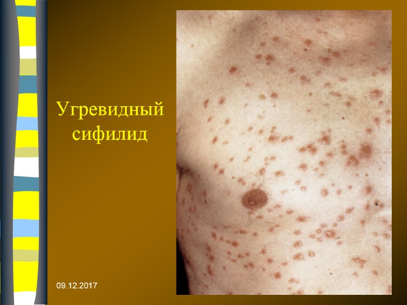 09.12.2017 Угревидный сифилид